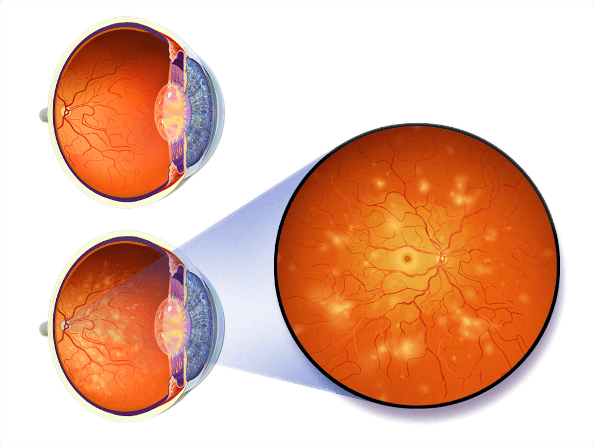 diabetic eye disease, diabetic retinopathy and diabetic macular oedema